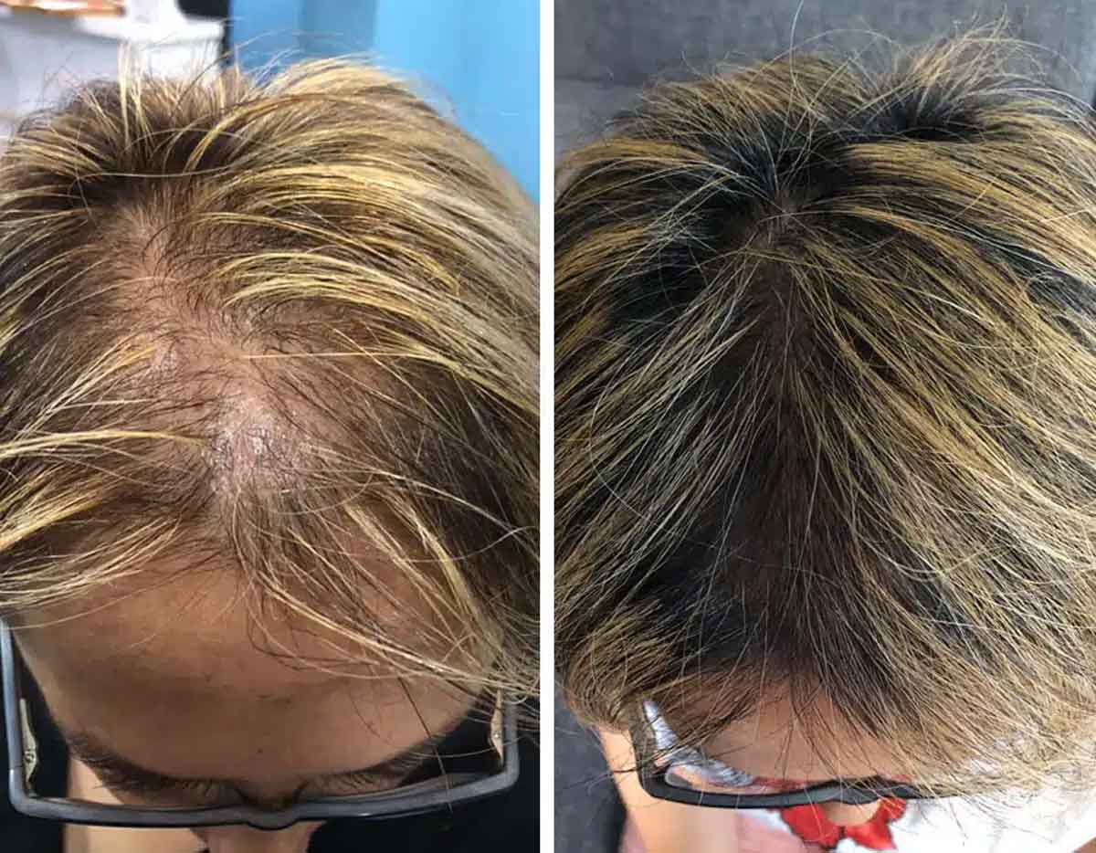 Mittel gegen Haarausfall